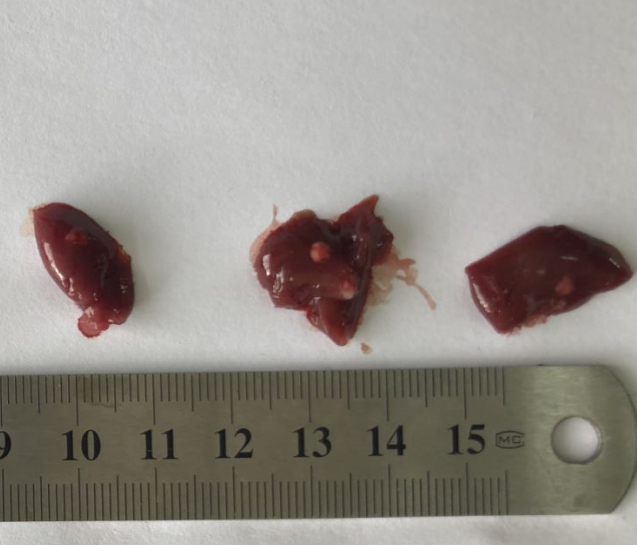 裸鼠肝转移瘤（脾转肝）(图1)